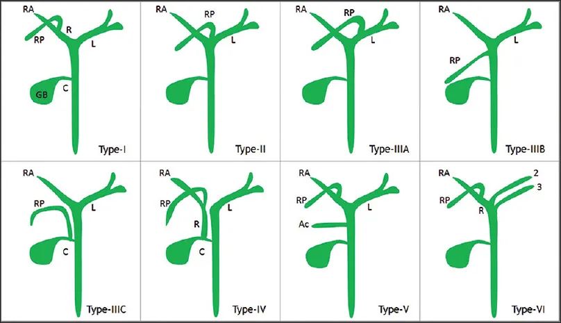 胆囊变异解剖图,胆道血供解剖