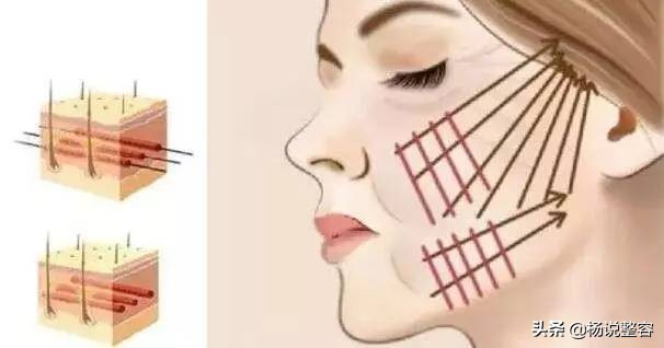 什么原因会导致法令纹越来越严重,脸上长了法令纹怎么淡化法令纹