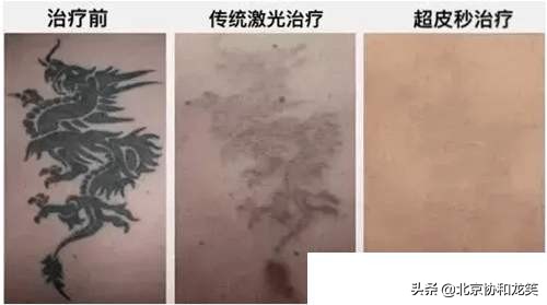 斑点橡皮擦真的能一秒祛斑吗,橡皮擦祛斑超皮秒用法