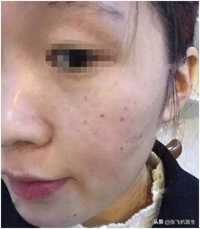 长斑最怕的3种食物,越吃越长斑的食物