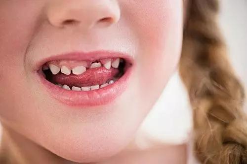 小孩有蛀牙牙疼怎么办生活小妙招,孩子蛀牙牙疼小妙招