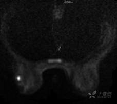 乳腺结节有消散的病例吗,一份完整的乳腺增生病例