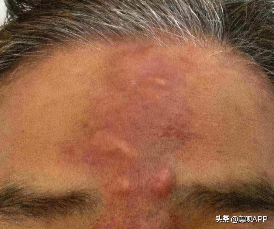 医美注射常识基础知识,医美注射风险