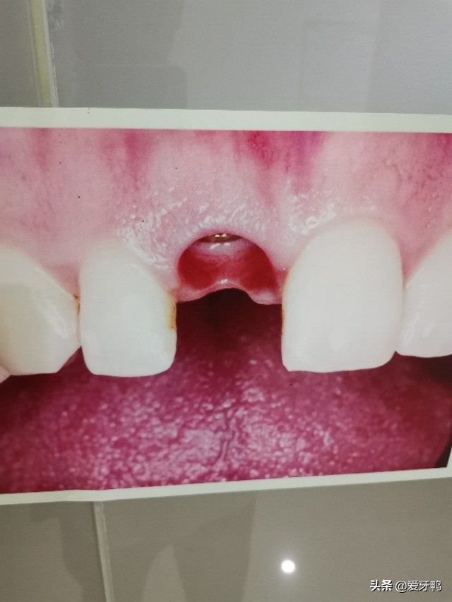 小孩把牙磕进去了怎么办,孩子磕到牙齿正确的处理方法