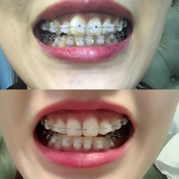 牙套日记一年级,牙套日记在线观看