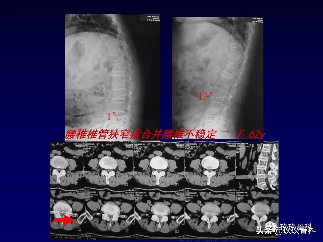 腰椎不稳最坏的结果,腰椎不稳的最佳治疗方法