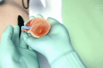 手术的时候医生对你做了什么,手术时切了一片肺叶