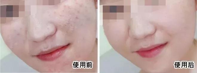 虾青素推荐新西兰,平价虾青素抗老精华