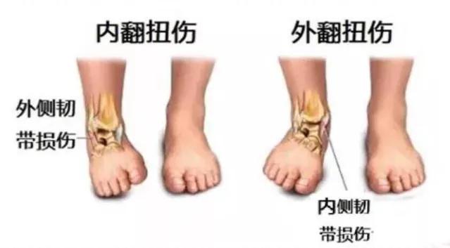 崴脚后应该热敷还是冰敷,崴脚五天了又肿了热敷还是冰敷