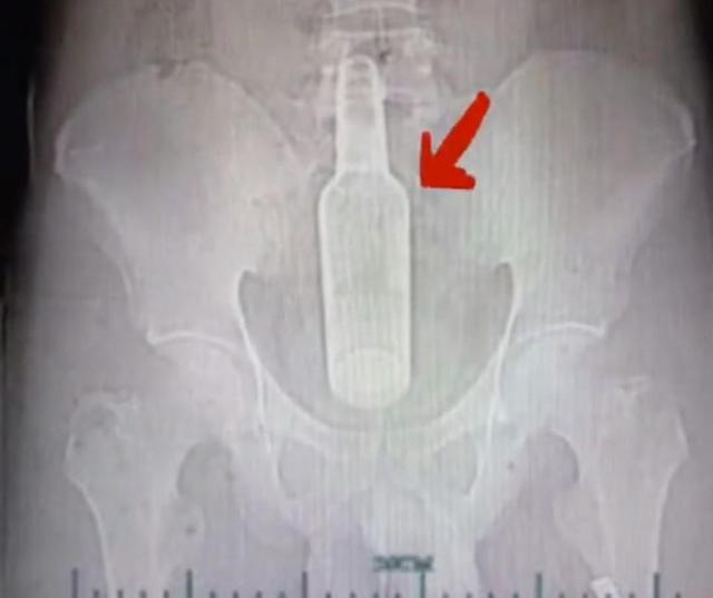 活久见！兴化男子为治便秘将黄鳝塞进直肠，黄鳝咬穿肠子进入腹腔