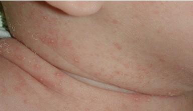 天气太热了宝宝长痱子怎么办,宝宝夏天痱子用什么方法消除最快