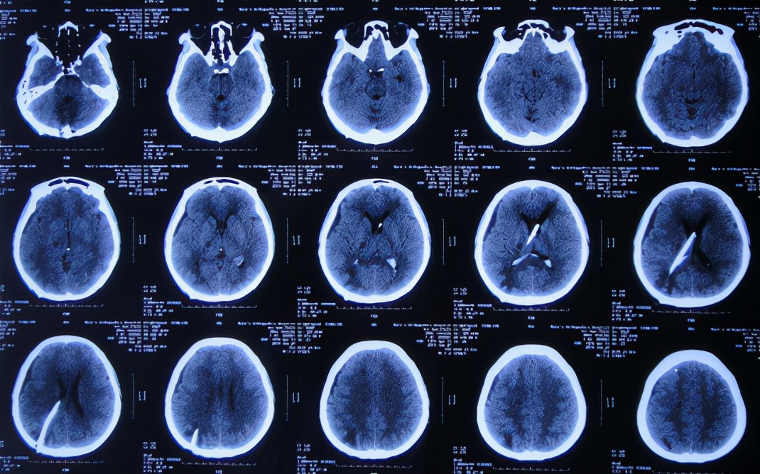 脑出血后脑积水会造成意识不清吗,脑出血后脑积水发高烧危险期多久