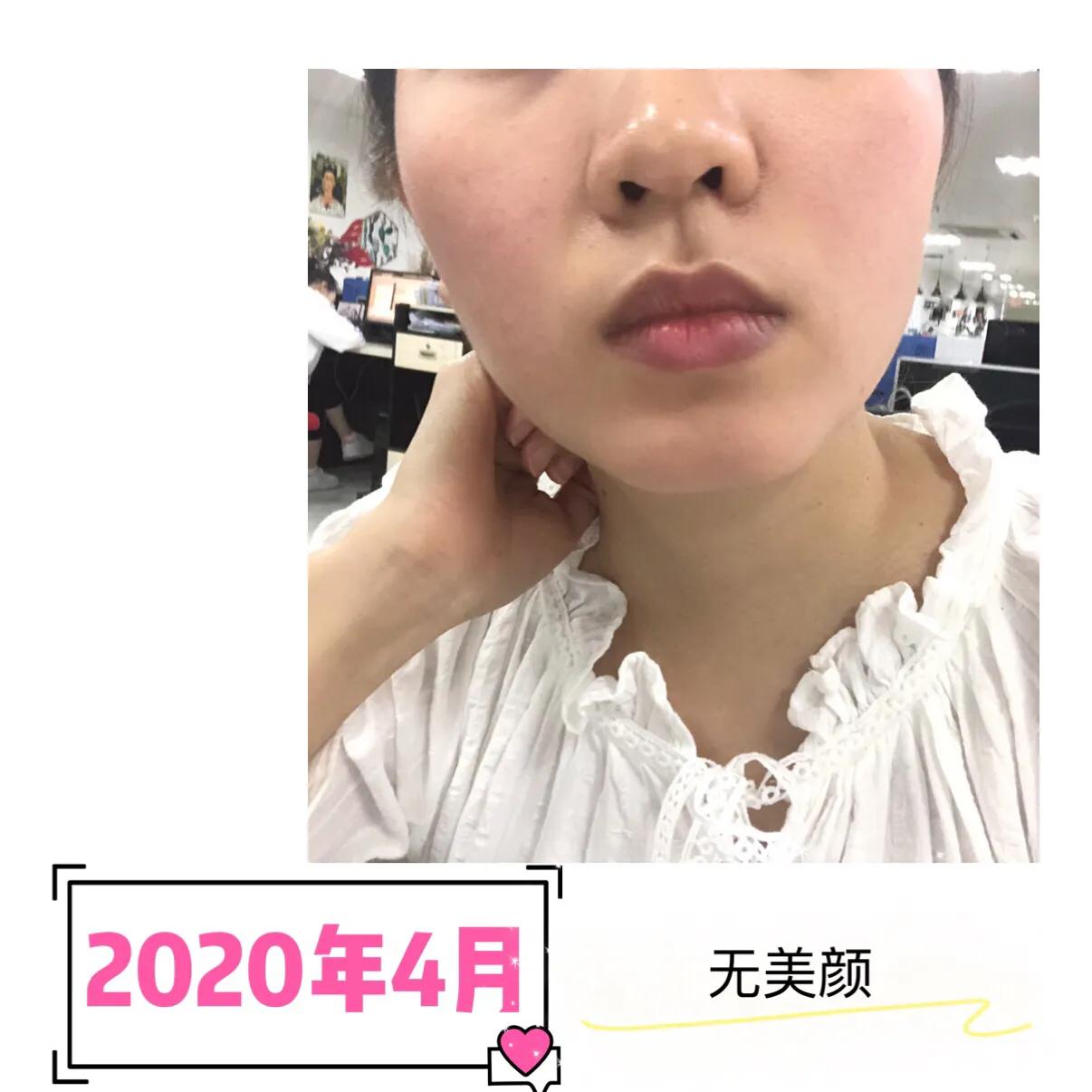 与病魔对抗的第30天,激素脸排毒第31天