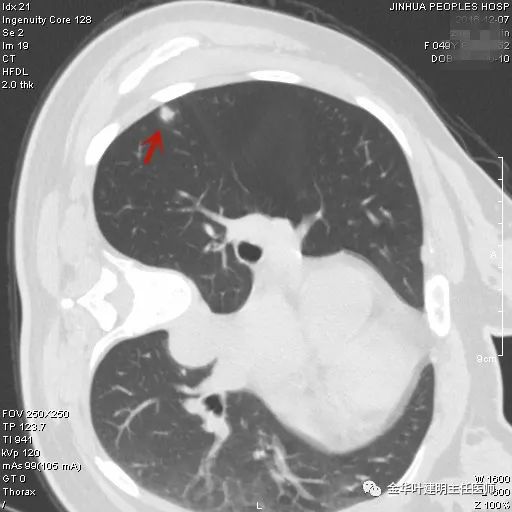 叶建明谈胸膜下的实性结节,叶建明肺实性良性结节会变癌症吗