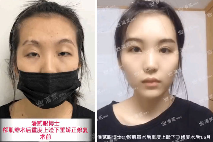 双眼皮离眉毛太近还能修复好吗,割双眼皮眉毛下面肿会消肿吗