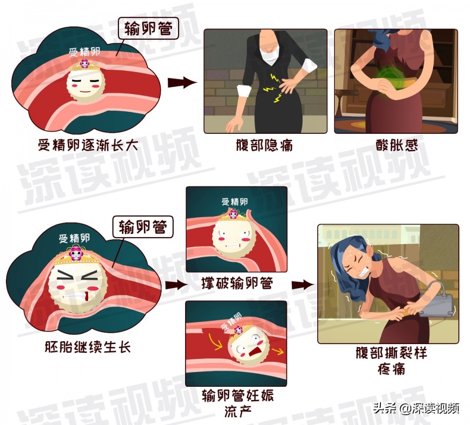 关爱女性|3.8妇女节深读特别节目——《宫外孕专题》