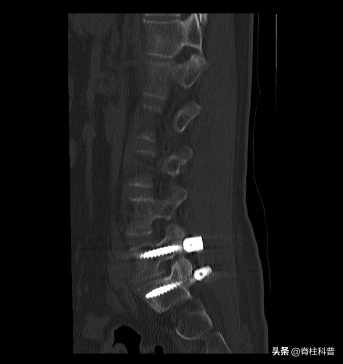腰椎间盘突出拍x光还是做磁共振,腰椎间盘突出要做核磁还是ct
