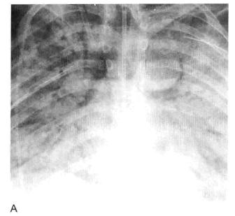 肺实变和肺炎的影像学区别,肺实变图