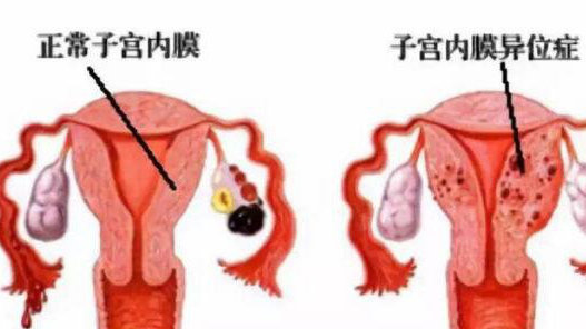 49岁妇女月经过后小腹疼痛咋回事,小腹隐隐作痛是什么原因没来月经