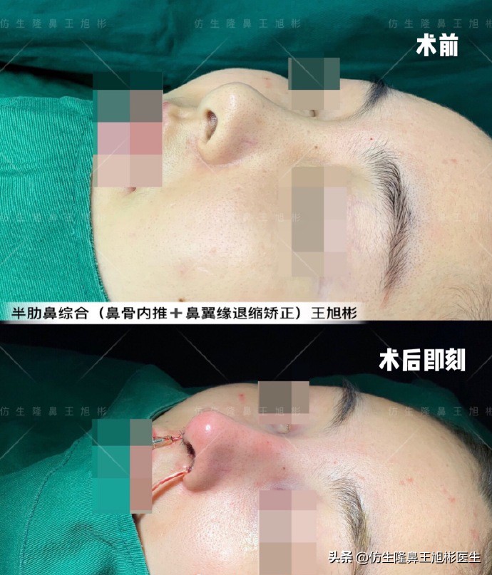 隆鼻的鼻翼怎么修复,隆鼻后多久可以做鼻翼缘矫正