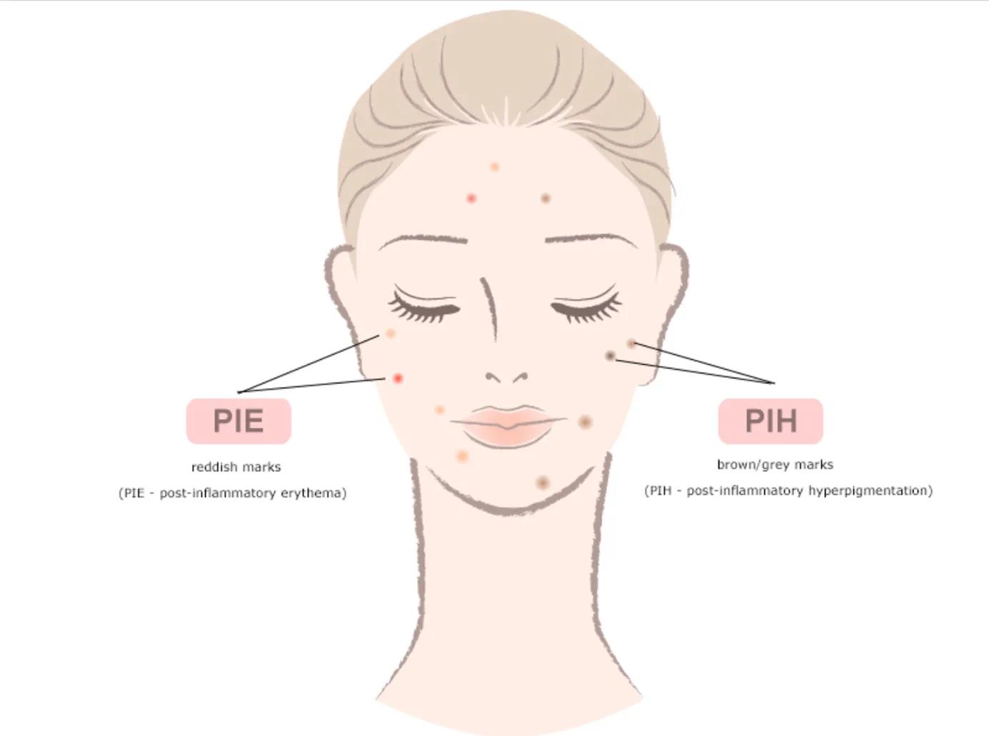 疱疹后遗症已三年了怎么办,痤疮后红斑怎么去除