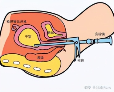试管查免疫反复移植不着床,一次试管失败要做宫腔镜吗