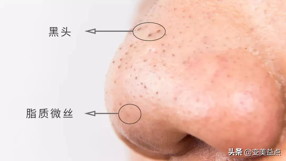 鼻头上很多油脂型黑头怎么办,鼻头黑头反复出现怎么解决