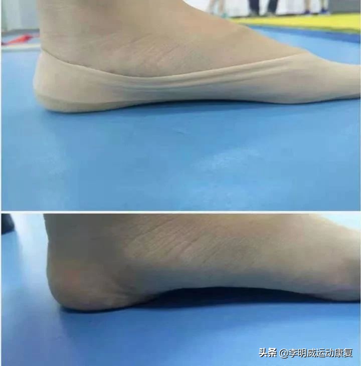 足外翻能不能治愈,足外翻能自己长好吗