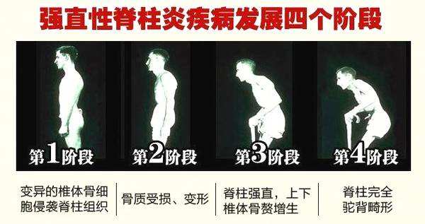 引起腰痛的常见疾病（五）“这些病也可以引起腰痛”