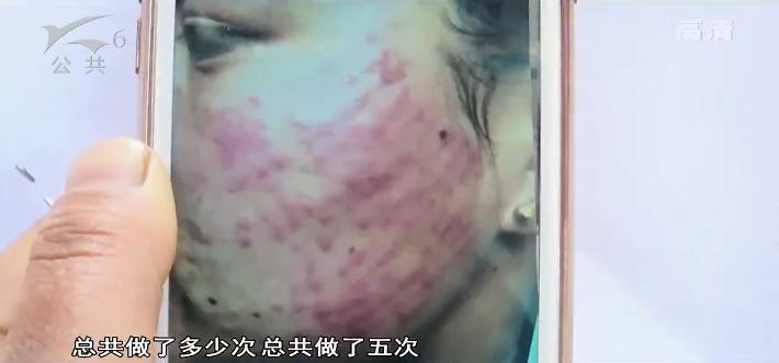 女子花万元治痘不见好转,花10万治疗痘坑