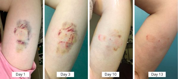 在美国做手术的体验,在美国做妇科手术