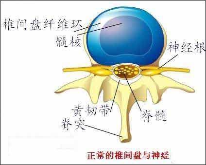 女性为什么会得腰间盘突出,女性腰椎间盘突出最佳锻炼方法