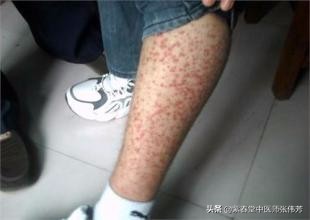 过敏性紫癜出现紫点,出血性紫斑跟过敏性紫癜有啥区别