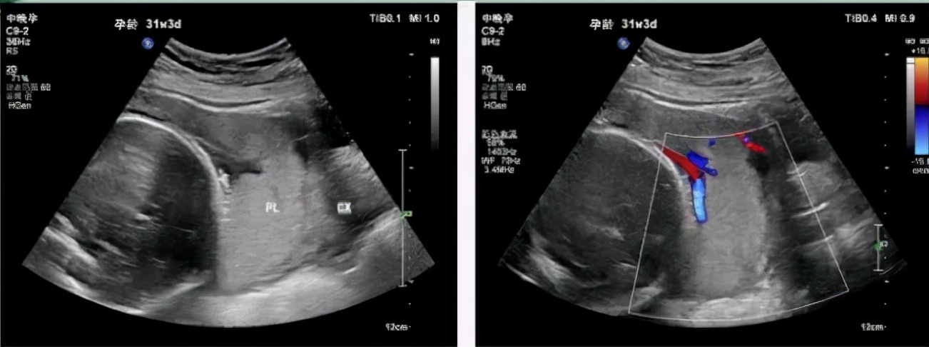 中央型前置胎盘要检查哪些项目,胎盘前置检查什么看得出来