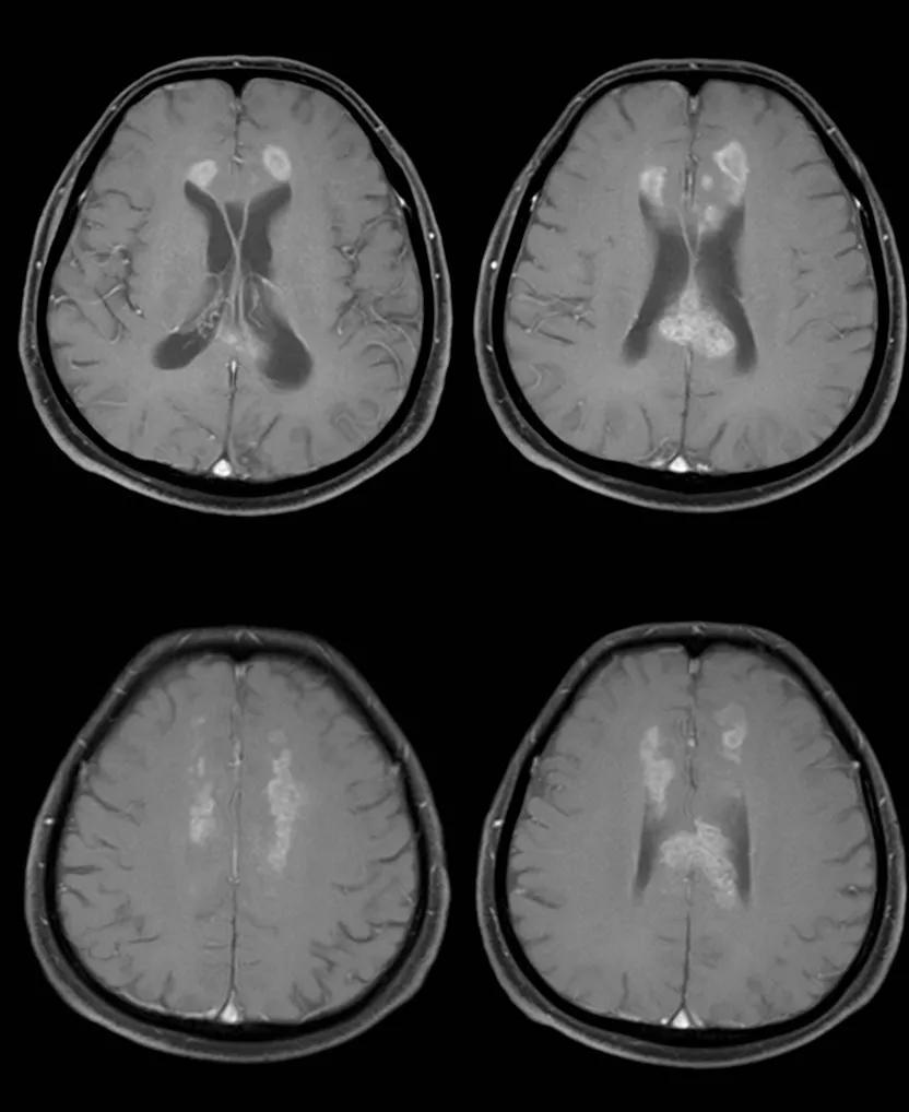 胼胝体有什么症状,胼胝体形态较小可以治疗吗