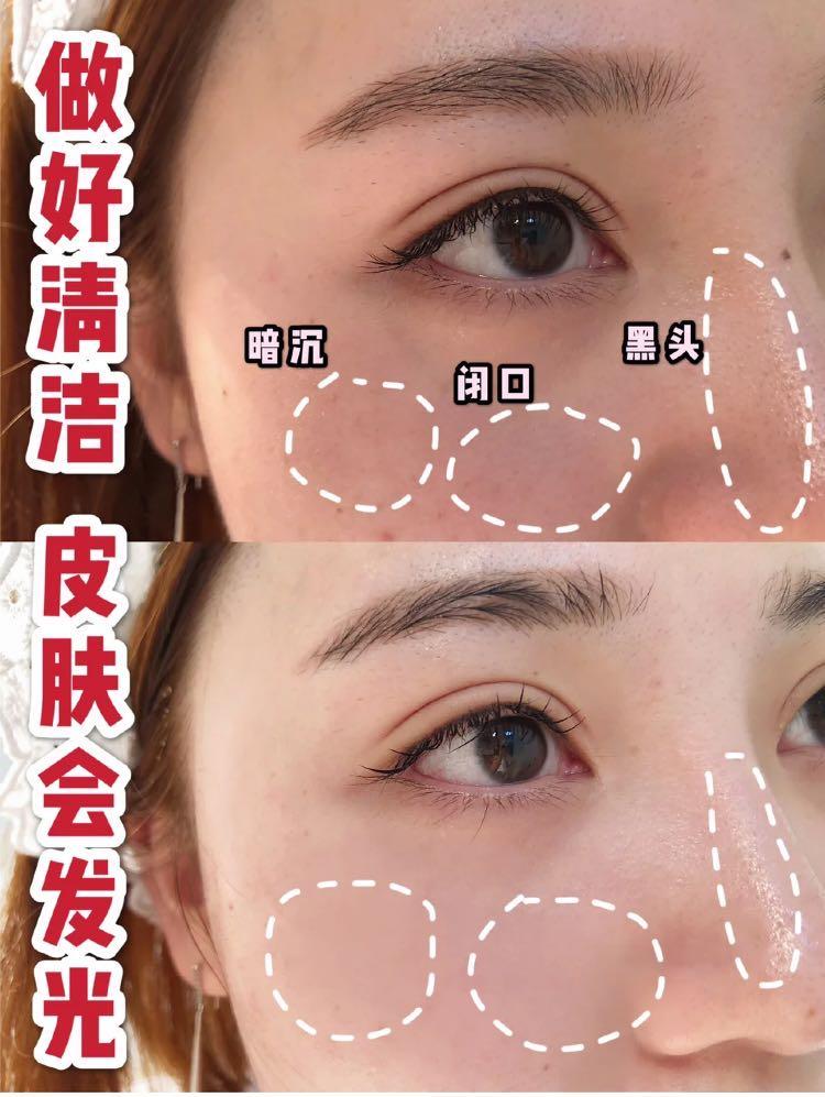 为了变美到底该不该打玻尿酸,玻尿酸注射后变丑了怎么办