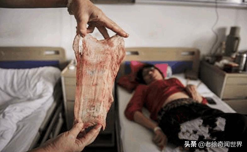 女子下身疼痛5年,医生从中取出一样东西,老公看后脸都气绿了