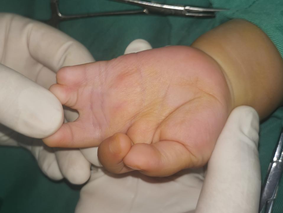 并指畸形免植皮案例,并指畸形