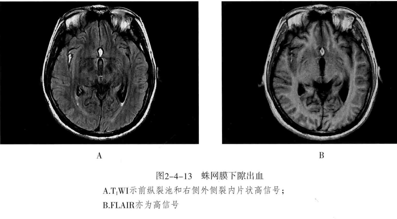 颅内血管周围间隙的影像鉴别,颅脑血管源性疾病影像诊断