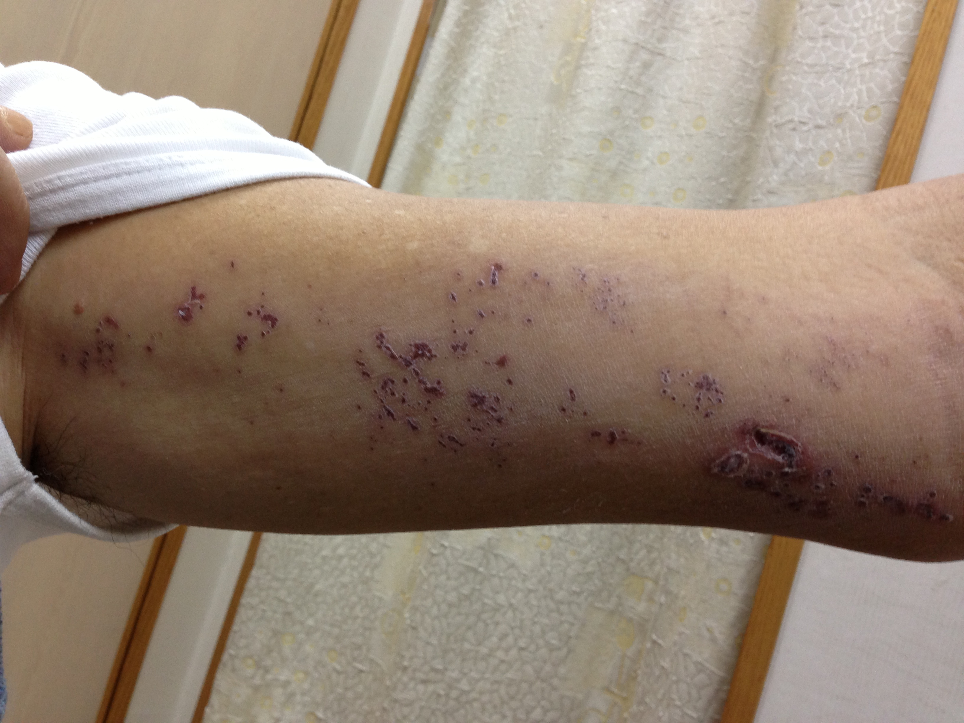 门诊日记全集,带状疱疹入院记录范文