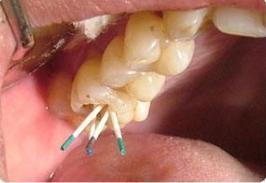 蛀牙在疼痛时期可以治疗吗,蛀牙早期不疼的时候怎么治疗