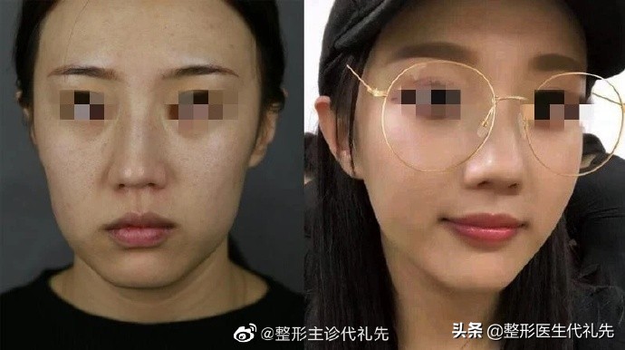 面部埋线提升能维持多久,面部埋线提升