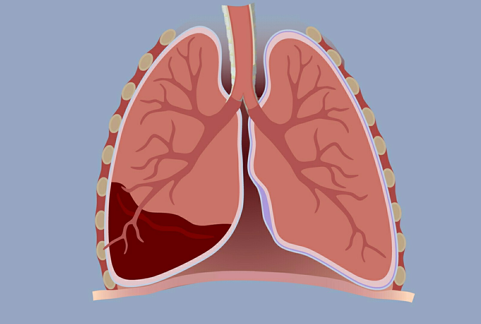 癌症病人胸腔积液后期会怎么排出,癌症病人出现胸腔积液怎么办