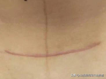 和平医院|肚脐“下刀”不留疤——和平医院开展“经脐单孔腹腔镜手术”