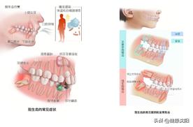 健康科普堂冬季,阻生齿对人体有哪些影响