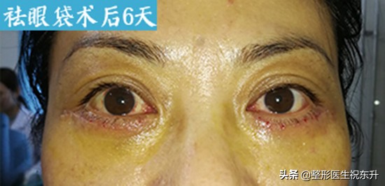 割眼袋和割双眼皮哪个风险大,男士眼袋手术内切有什么风险