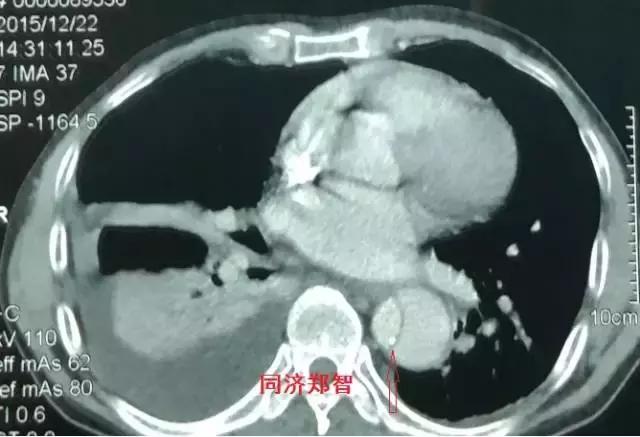 磁共振可以替代cta检查主动脉夹层,主动脉夹层cta上如何分辨真假腔