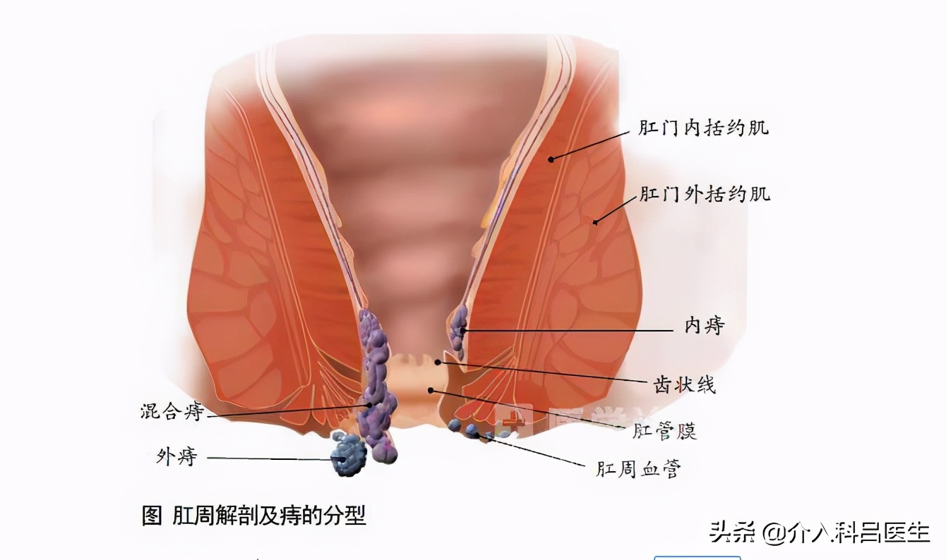 痔疮肉球排便出血要做手术吗,痔疮有肉球脱出流血怎么办