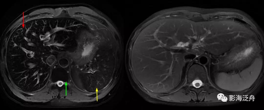 肝脏弥漫性病变严重吗,肝脏弥漫性的病变的症状