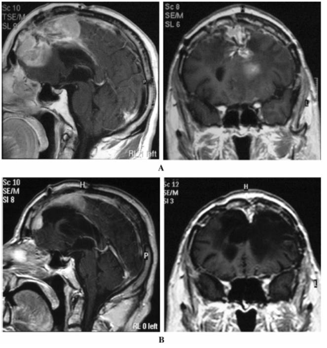胶质脑瘤开颅后又复发能活多久,脑瘤开颅三十年复发